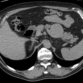 CT pancreas with (a) pre-contrast, (b) arterial phase, and (c) portal venous phase images. There is a mass lesion arising from the inferior portion of the tail of the pancreas measuring 5.8 cm. There is heterogeneous arterial enhancement with persistent enhancement in the venous phase. There is no washout.
