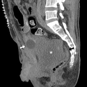 In both axial (1a) and sagittal (1b) reformations of the pelvis, a large pelvic mass (asterisk) is seen compressing the rectum (black arrow) and displacing the bladder catheter anteriorly (white arrow). Note that the mass shows no calcifications.