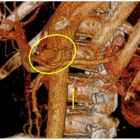 Vascular 3D map shows both vascular irregularities, left renal artery stenosis (arrow) and the fusiform celiac trunk dilation (circle).