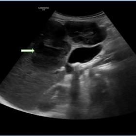 Liver sonography showed a heterogeneous hypoechoic lobulated liver mass in the right lobe of the liver (white-green arrow).