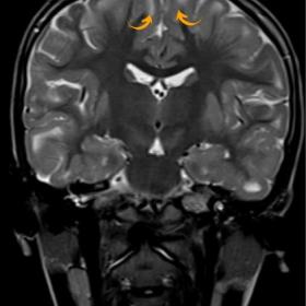 Coronal T2WI shows multifocal, partly confluent, subcortical T2 hyperintensities in bilateral cerebral hemispheres involving 