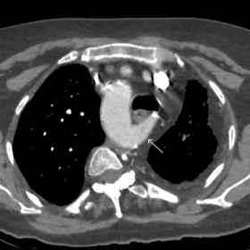 Axial CTA chest showing a right aortic arch with an aberrant left subclavian artery with a retroesophageal trajectory (white 