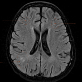 Axial FLAIR showing small patchy asymmetric subcortical white matter FLAIR hyperintensities region in the right parietal lobe