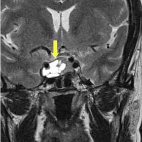 Coronal T2 weighted image. The pituitary gland is enlarged. Asymmetric enlargement in the right lateral aspect is evident. Mu