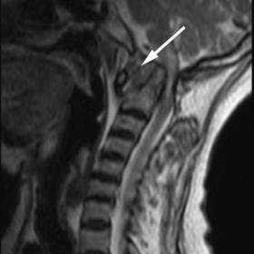 Sagittal T2 weighted non-contrast MRI image at the craniovertebral junction shows hypointense to isointense soft tissue pannus formation between the body of C1 and the dens (white arrow).