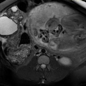 Axial fat-suppressed T2-weighted image shows an adnexal tumour with solid and cystic components, multilocular, with thickened