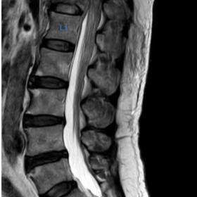 Sagittal T2WI shows central compression of T12 vertebral body extending to the posterior aspect of vertebral body focal increased signal with swelling of conus, suggestive of oedema.