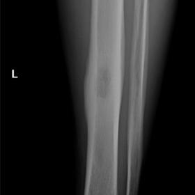 Frontal radiograph of the left tibia and fibula. Geographic lytic lesion (type 1B) in the tibial diaphysis with thick continuous periosteal reaction.
