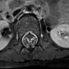 T1-weighted gadolinium post-contrast axial section at the level of cauda equina nerve roots showing thickening and enhancement of cauda equina nerve roots. Note that anterior nerve roots are thickened and show more enhancement compared to posterior nerve roots, which is typical of GBS.