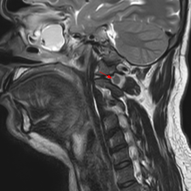 Sagittal T2W image of the cervical spine shows hypertrophy of the left dorsal nerve root ganglion at the C1–2 level (red a