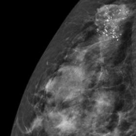 Mammographic views of the right breast. a: Extended craniocaudal view, demonstrating a heterogenous mass with a “cloudlike” appearance within the axillary tail.