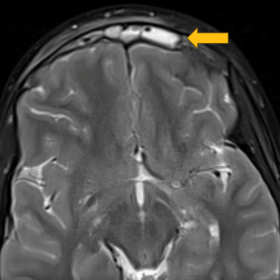 Axial T2 with frontal sinusitis (arrow).