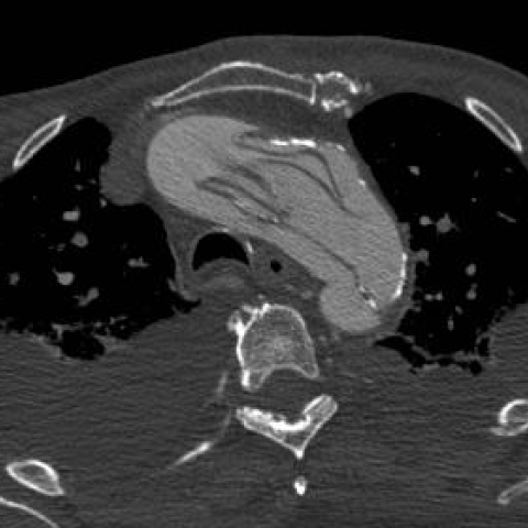 irad aortic dissection