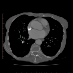 CT image at level of right lower lobe pulmonary artery