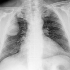 Posteroanterior and lateral chest radiographs