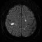 Axial diffusion weighted image