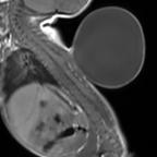 Sagittal T1 MRI shows a large, well-defined T1 hypointense lesion at the level of the lower thoracic spine.