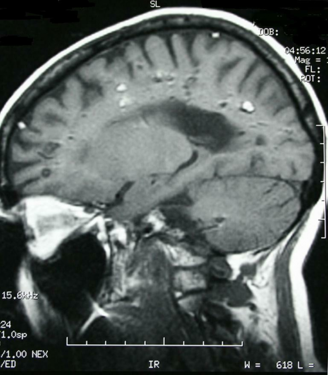 Multiple Cavernous Haemangiomas of the Brain | Eurorad
