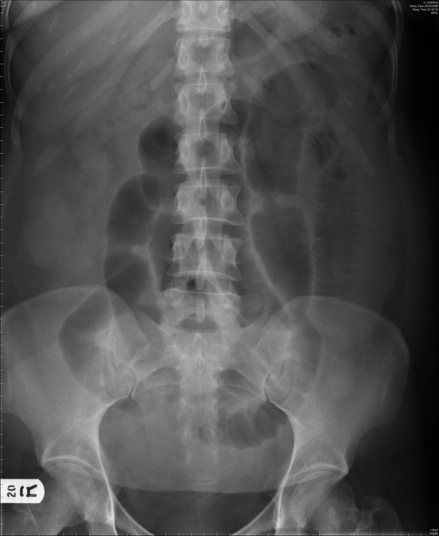 Small bowel obstruction secondary to appendiceal mucocele ...