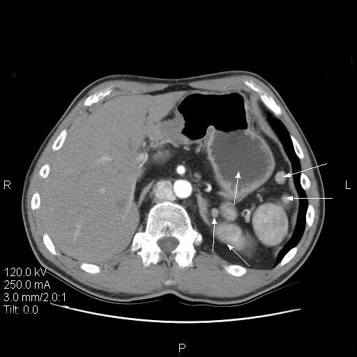 An Incidental Finding of Polysplenia with Intraperitoneal Pancreas and ...