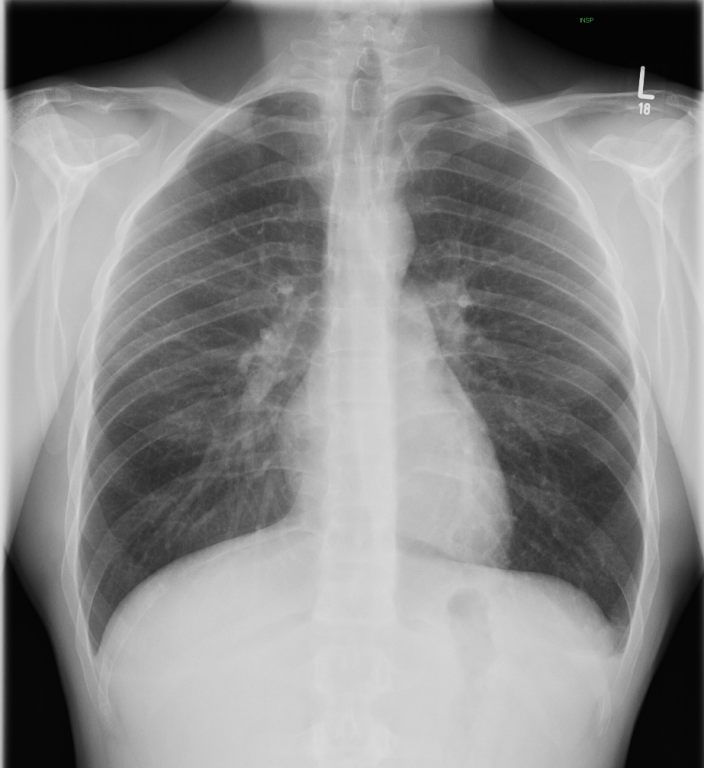 Dual energy chest radiography facilitates pneumothorax detection | Eurorad