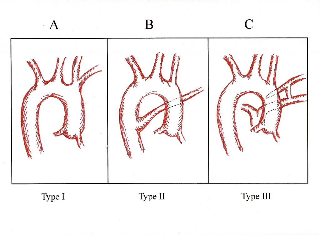 Right Aortic Arch In Asymptomatic Adult Eurorad