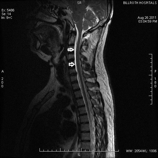 Spinal MR findings in a case of spontaneous intracranial hypotension ...