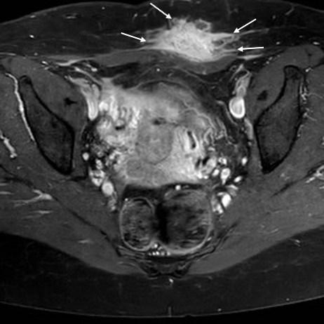 Abdominal wall endometriosis: MRI findings and the “Gorgon sign” | Eurorad