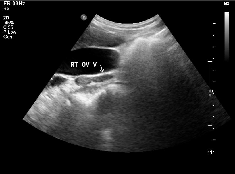Isolated right ovarian vein thrombosis mimicking acute appendicitis ...