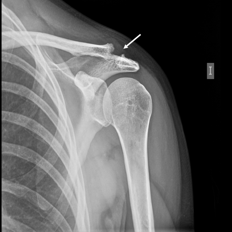 Post Traumatic Osteolysis Of The Distal Clavicle Eurorad