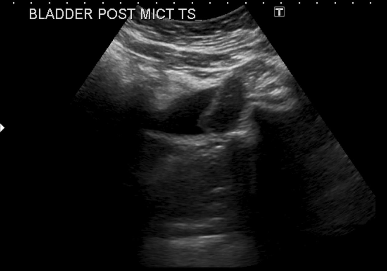 cpt code for post void bladder scan