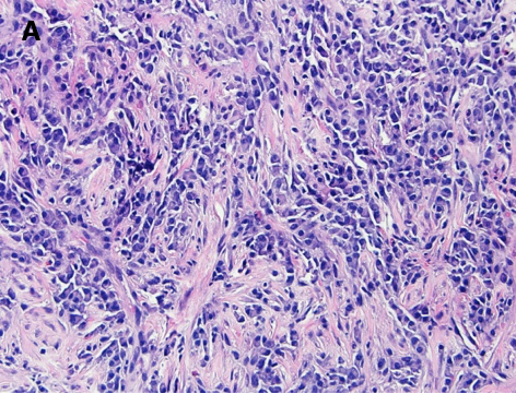 Inflammatory myofibroblastic tumor of the liver: A case report | Eurorad
