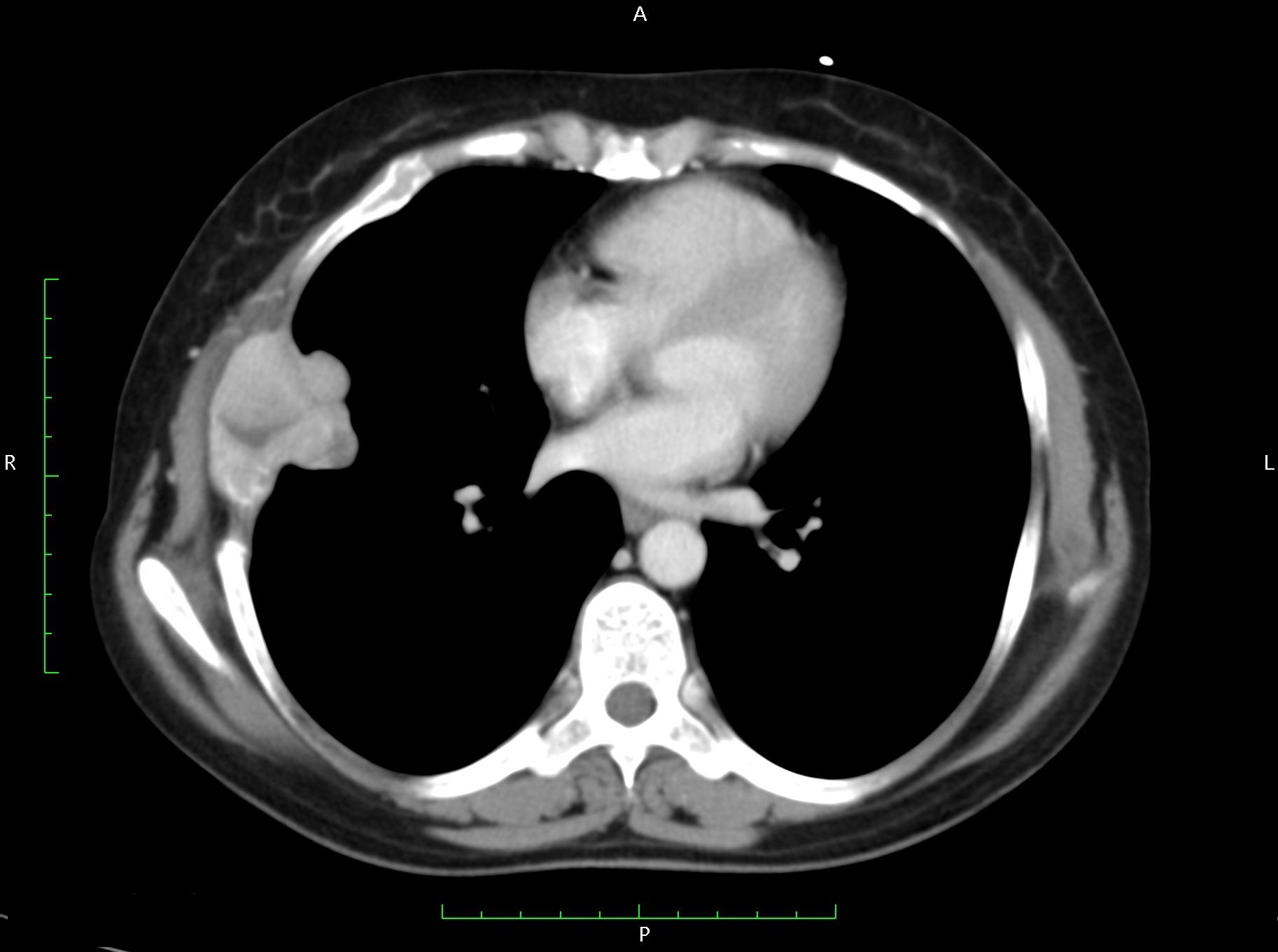 Brown tumour and its differential diagnosis: Challenges in radiological ...