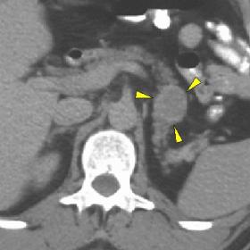 Computed Tomography (CT) of the upper abdomen