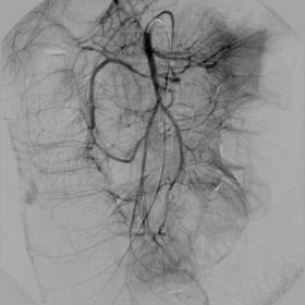 Mesenteric arteriography