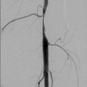 Popliteal artery stenosis