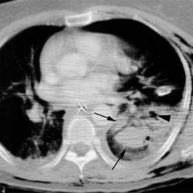 Blunt traumatic pulmonary lacerations devoid of surrounding pulmonary contusions
