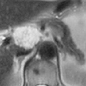 T2-weighted MR image