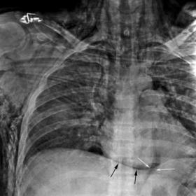 Blunt traumatic pneumomediastinum and subcutaneous emphysema consecutive to rib fractures