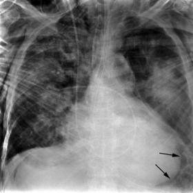 Blunt tracheal rupture with subsequent pneumomediastinum, pneumoperitneum, as well as subcutaneous and muscular emphysema