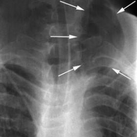 Combined blunt tracheal and esophageal ruptures at the cervical level, with subsequent cervical emphysema