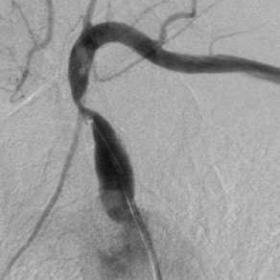 Subclavian artery stenosis