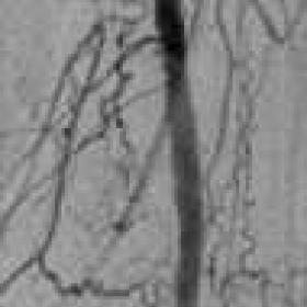 Acute thrombotic occlusion of femoral artery