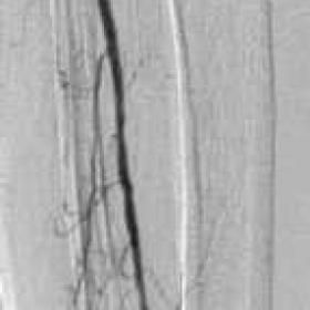 Occlusive disease of right anterior tibial artery