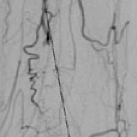 Subacute occlusion of the left popliteal artery