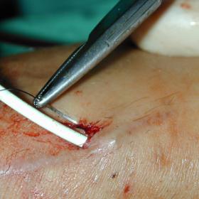 How to perform a subcutaneous purse string suture
