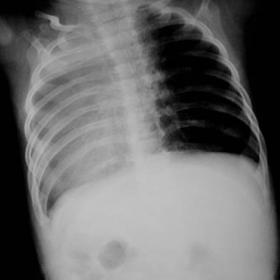 Plain chest radiograph