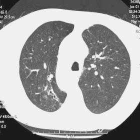 HRCT chest scans