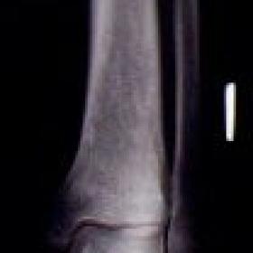 860_1a.jpg. X-ray of the left tibia: evidence of cortical thickening of the tibial diaphysis.