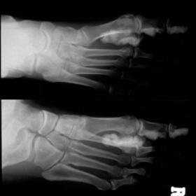 Preoperative right foot